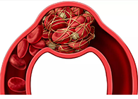 令人“心惊胆战”的脑卒中发明治疗新机制！